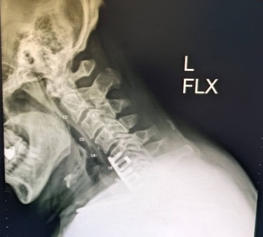 Name:  Neck X-Ray, L-Flex, Jun 2022 - cropped.jpg
Views: 2898
Size:  30.2 KB